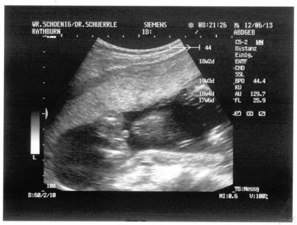 Ultrasound 12June2013d